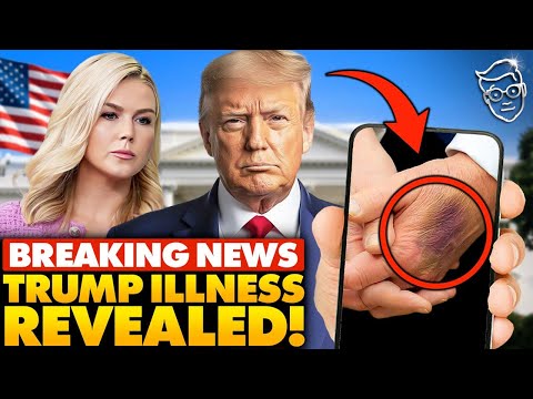 You are currently viewing White House Spins Trump’s Health After Viral ‘Brusing’ Photos